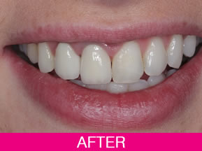 straight teeth treatment after
