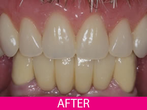 denture and bridge after