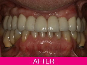dental implants after