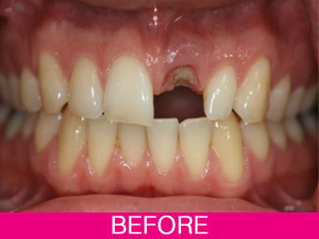  single dental implants before